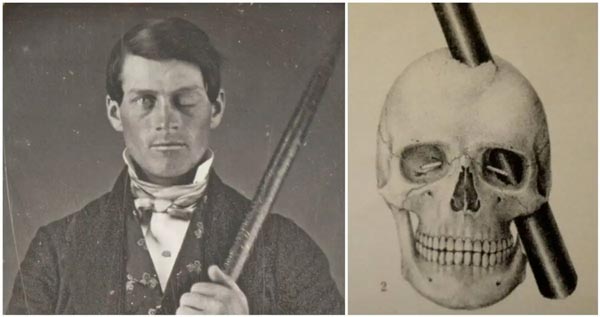 Phineas Gage and his damaged skull.
